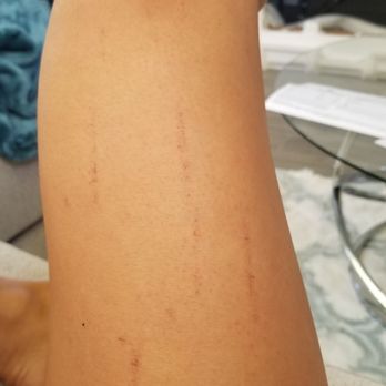 SkinRenuit Medspa - Burn marks that scabbed over from laser hair removal - Medical Spas Near Me - Poway, California SkinRenuit Medspa - Burn marks that scabbed over from laser hair removal - Medical Spas Near Me - Poway, California