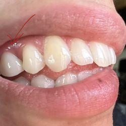 Divine Dental - Root canal & permanent crown