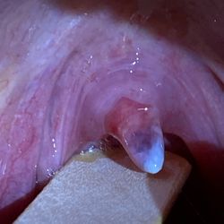 Anthony Williams, MD - This is a picture of my mother's uvula 1 day after the endoscopy. Notice how the uvula is shiny and transparent - grade 1 uvular necrosis