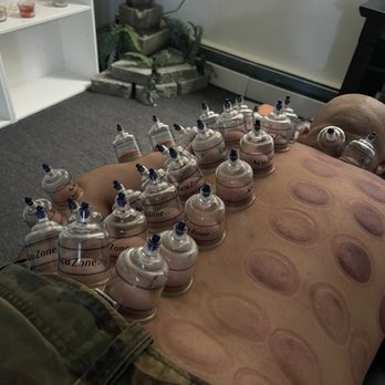 Thrive Physical Therapy and Massage - Cupping therapy - Physical Therapy Near Me - Dearborn, Michigan