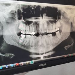 Upland Dental Group And Implant Center - Here is a xray of my mouth & area they removed the tooth from. Apparently, area has an infection and it has been 4 weeks since the extractio