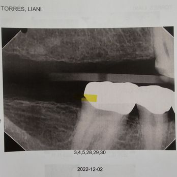 Great Expressions Dental Centers - This is the tooth that got a cavity under it and i had to pull it due to finances. - General Dentistry Near Me - Austin, Texas Great Expressions Dental Centers - This is the tooth that got a cavity under it and i had to pull it due to finances. - General Dentistry Near Me - Austin, Texas