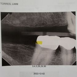 Great Expressions Dental Centers - This is the tooth that got a cavity under it and i had to pull it due to finances.