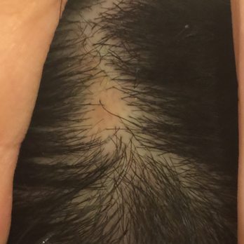 Sew Brooklyn - This is the bald spot left behind after one of the scabs healed up - Hair Stylists Near Me - Brooklyn, New York Sew Brooklyn - This is the bald spot left behind after one of the scabs healed up - Hair Stylists Near Me - Brooklyn, New York