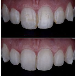 Marlton Dental Care - Resin Infiltration done to remove brown stains
