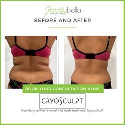 Body Bella Wellness Center - CryoSculpt 45 day before and after of bra rolls and love handles.