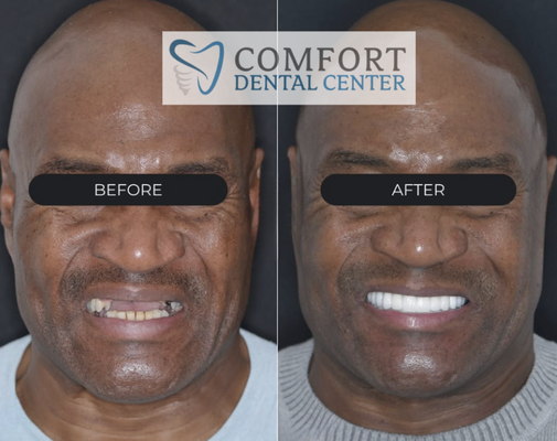 Full Mouth Reconstruction+Implants - Before and after transformations