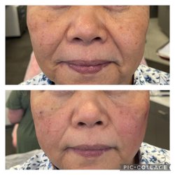 On The Go VIP Spa - Lunch Time Face-lift using PDO Threads