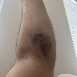 Labcorp at Walgreens - Nearly losing my arm at Labcorp