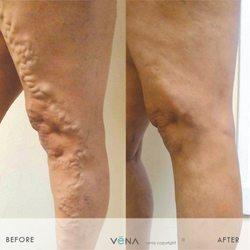 Vena Vein Clinic - Sherman oaks