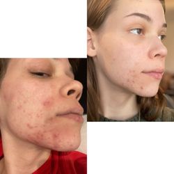 Uesthetics - Before my first treatment (the left) and this was on a good day  To After my first treatment (the immediate difference )
