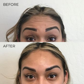 Sani Aesthetics, MD - Botox Before and After - Medical Spas Near Me - San Jose, California Sani Aesthetics, MD - Botox Before and After - Medical Spas Near Me - San Jose, California