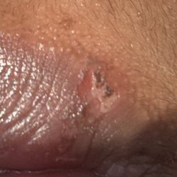 East Broad Family Dentistry - This is a picture of the burn on my lips from the Dental drill later in the day