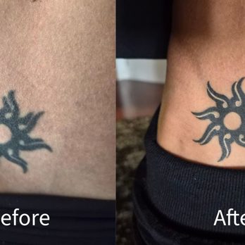 Fleur Noire Tattoo - Before/After Photo - Tattoo Near Me - San Diego, California Fleur Noire Tattoo - Before/After Photo - Tattoo Near Me - San Diego, California