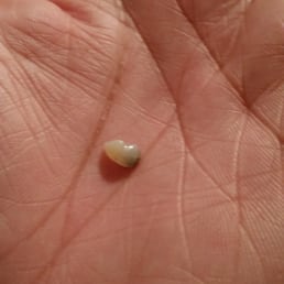 Piece of tooth broken from whatever was put in the pizza that shouldnt have been there. Piece of tooth broken from whatever was put in the pizza that shouldnt have been there.
