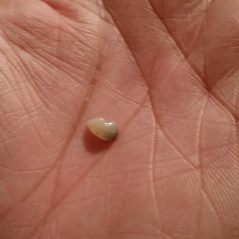 Papa Murphy's - Piece of tooth broken from whatever was put in the pizza that shouldnt have been there. - Pizza Near Me - Renton, Washington Papa Murphy's - Piece of tooth broken from whatever was put in the pizza that shouldnt have been there. - Pizza Near Me - Renton, Washington