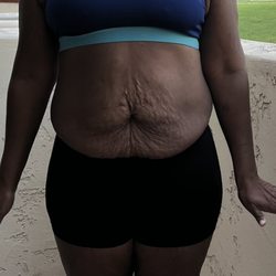 Raad Taki, MD - Before surgery Surgery was 7/2023