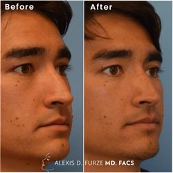 Alexis Furze, MD - "Rhinoplasty complete--breathing restored, confidence renewed, results looking natural."