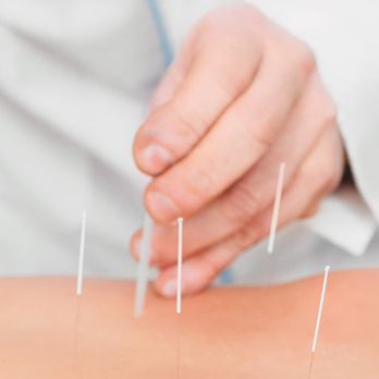 True Acupuncture - Acupuncture Near Me - Chandler, Arizona True Acupuncture - Acupuncture Near Me - Chandler, Arizona