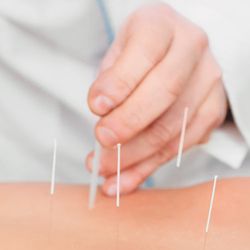 True Acupuncture