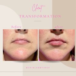 Juvederm Volbella for soft volume