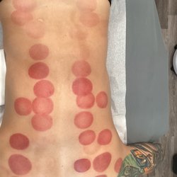 Lina East Acupuncture - Cupping