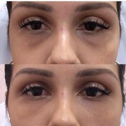 Undereye filler