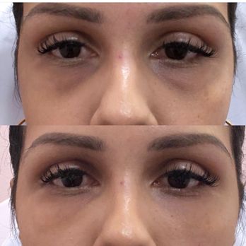 NUVO Cosmedispa - Undereye filler - Medical Spas Near Me - Houston, Texas