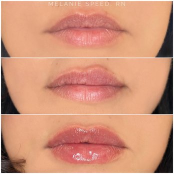 Flawless MedSpa by Melanie Speed