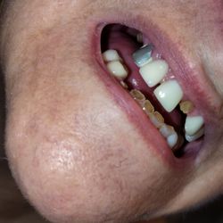 Hurd Family Dental - My mouth after Mr. Hurd's destruction.
