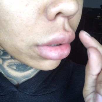 Devine Image - The very obvious filler above my lips under my nose :( I had to be like this for a month before they would do anything! - Medical Spas Near Me - Tustin, California