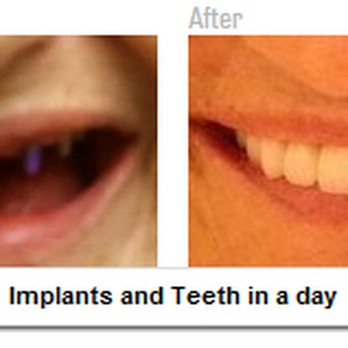 Friedman Dental Group - Implants and Teeth in a day - Cosmetic Dentists Near Me - Plantation, Florida Friedman Dental Group - Implants and Teeth in a day - Cosmetic Dentists Near Me - Plantation, Florida