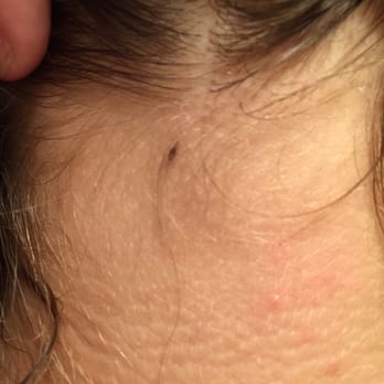 A Lice Bug At The Base Of My Daughters Hair Line Visited The Lice