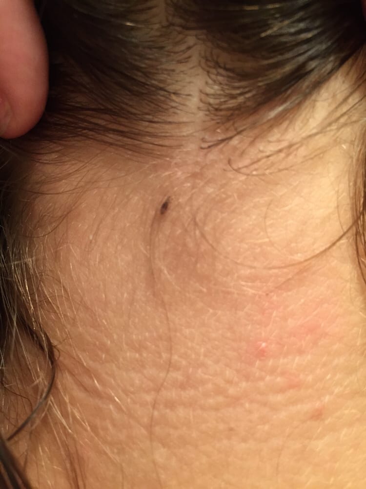 The Lice Place Tratamiento Para Eliminar Piojos 21830
