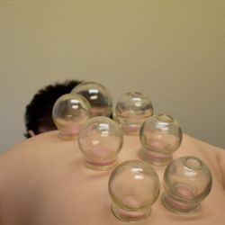 ShuiLian Yu Acupuncture - Cupping helps to loosen muscles, encourage blood flow and can balance the nervous system