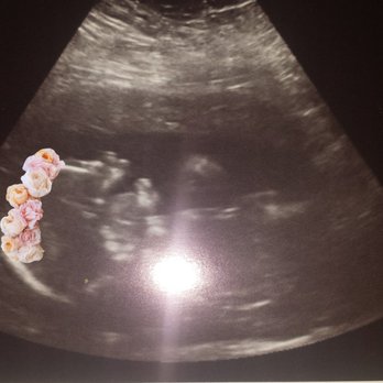 Baby's First Photos - Our baby girl was yawning in this pic. - Diagnostic Imaging Near Me - Bakersfield, California