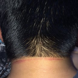 Cuts and bruise left on the back of my neck. This is the day after my haircut. Cuts and bruise left on the back of my neck. This is the day after my haircut.