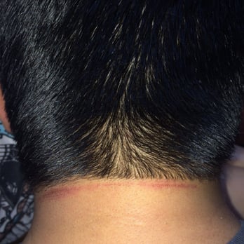 Wilson's Classic Barber Shop - Cuts and bruise left on the back of my neck. This is the day after my haircut. - Barbers Near Me - Redlands, California Wilson's Classic Barber Shop - Cuts and bruise left on the back of my neck. This is the day after my haircut. - Barbers Near Me - Redlands, California