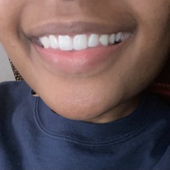 Impress - After impress... no spaces or gaps Finally - Orthodontists Near Me - San Francisco, California