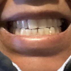 OrthoWorks - Hercules - Spaces and crooked teeth due to retainers not being molded correctly