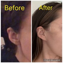 Robb Facial Plastic Surgery - Dr. Philip K. Robb Jr - Before: nice sharp angle in jawline, rounded earlobe and tragus, no tension/ pulling on facial skin. After: pixie ear deformity