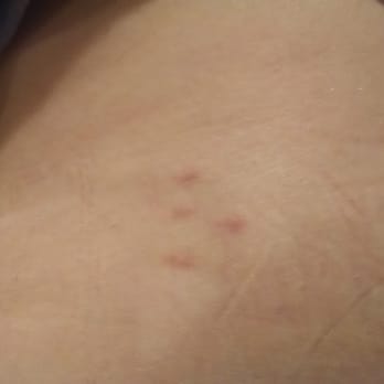 Sheraton Stonebriar Hotel - Bed bug bites - Hotels Near Me - Frisco, Texas