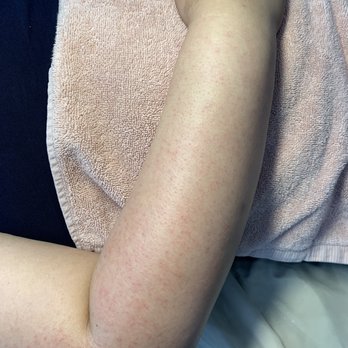Paste the Sugar Place - Half arm sugaring results immediately after - Sugaring Near Me - Anaheim, California Paste the Sugar Place - Half arm sugaring results immediately after - Sugaring Near Me - Anaheim, California