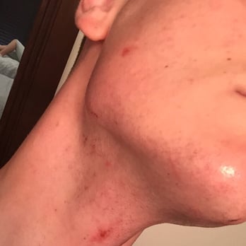 Hank's Barber Shop - My literal injuries from his shaving job - Barbers Near Me - Camarillo, California
