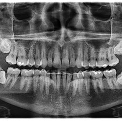 Gordon Mathew, MD DDS - Those Crazy Wisdoms are gone now.