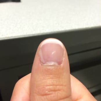 Day Yoga Studio - thumb nail peeling up, 1 day after - Yoga Near Me - Dayton, Ohio