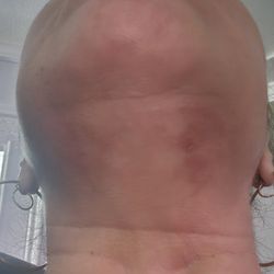 Beverly Hills Rejuvenation Center - Coolsculpting gone wrong