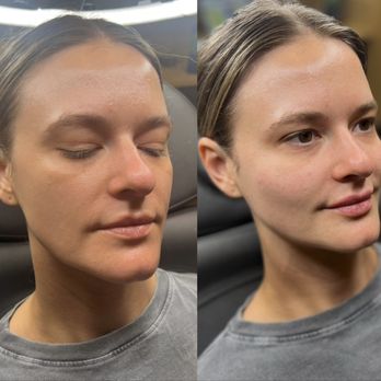 Just Injected - Sculptra before and after in Dallas. - Medical Spas Near Me - Dallas, Texas Just Injected - Sculptra before and after in Dallas. - Medical Spas Near Me - Dallas, Texas