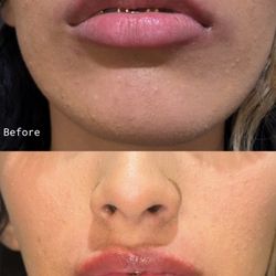 Bella Rejuvenation Cosmetic Center - Lip Filler Before and After using Juvederm
