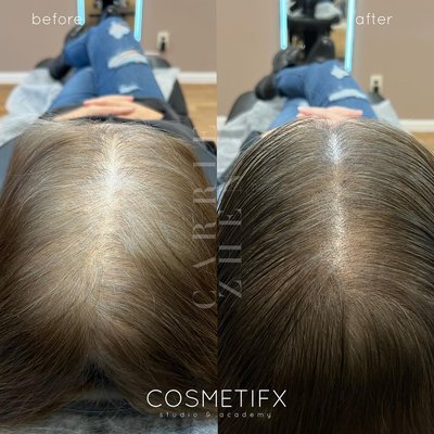 Scalp Micropigmentation - Hair Density (Before & After) - A collection of results of before and after SMP HD Scalp Micropigmentation - Hair Density (Before & After) - A collection of results of before and after SMP HD